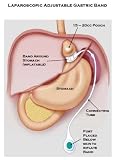 The Truth About Lapband Surgery