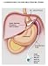 Search : The Truth About Lapband Surgery