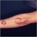 Search : 'Psoriasis' Questions and Answers