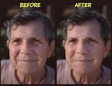 Wrinkle Reduction and Skin Rejuvenation
