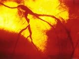 Coronary Angiogram Left Anterior Decending Artery Photographic Poster Print, 18x24