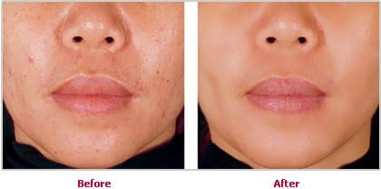 Revivaderm Basic Blackhead Treatment-3 Piece Kit