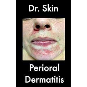 Perioral Dermatitis