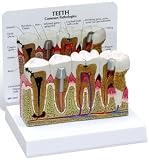 Human Teeth and Gums Model Normal and Diseased
