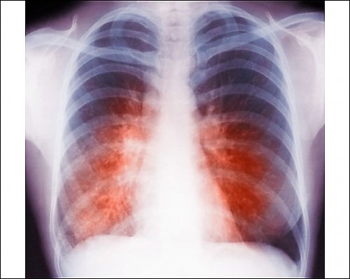 tuberculosis x ray. Photographic Print of Tuberculosis X-ray from Science Photo Library