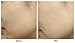 Reskin Trouble Solution Spot Plus - Advanced Acne Spot Treatment, Contains Salicylic Acid and Natural Plant Extracts