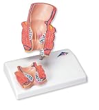 3B Scientific Hemorrhoid Model 3B Scientific Hemorrhoid Model