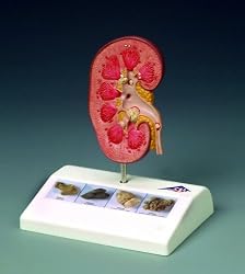 Lippincott Williams + Wilkins Kidney Stone Model