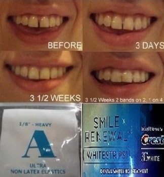 ORTHODONTIC GAP TEETH BANDS 1/8 HEAVY WITH WHITE STRIPS INTERNATIONAL SHIPPING by GAPFIX