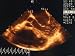 Doppler Transesoph. Echo. Ultrasound Lutembacher Syn Photographic Poster Print, 18x24