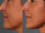 50% Glycolic Acid Home Chemical peel for sun damage, lines, acne and age spots 1 Fl Oz
