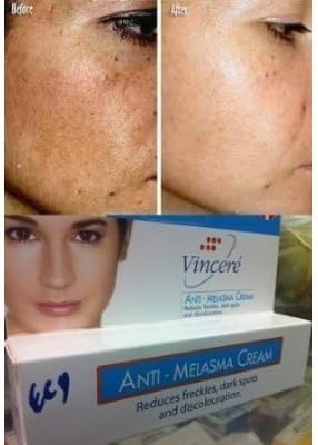 Best Cream Anti Melasma Reduces Age Spots, Sun Spots, Pigmentation, Freckles 15 G.