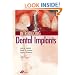 Introducing Dental Implants