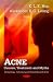 Acne: Causes, Treatment & Myths