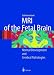 MRI of the Fetal Brain: Normal Development and Cerebral Pathologies