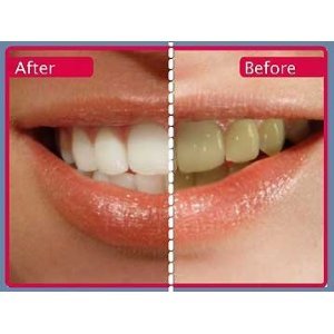Professional Teeth Whitening Kit 