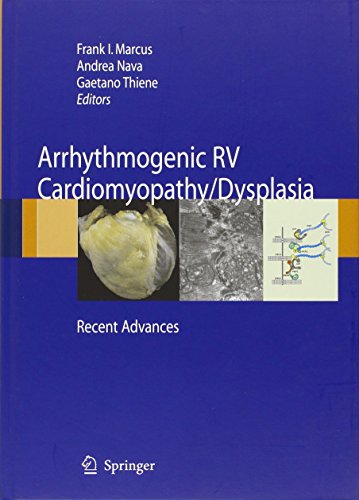 arrhythmogenic rv cardiomyopathydysplasia recent advances