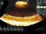 Transeophageal Echo Aorta with Heavy Atherosclerosis Photographic Poster Print, 12x16