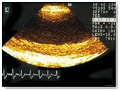 Transeophageal Echo Aorta with Heavy Atherosclerosis Photographic Poster Print, 12x16