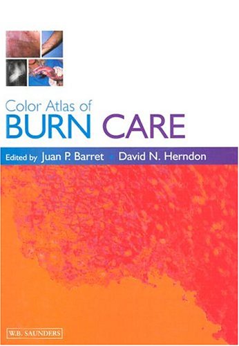 Burns