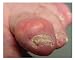 Questions and Answers about Gout