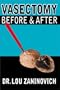 Vasectomy - Before and After