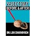 Vasectomy - Before and After