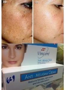Best Vincere Anti Melasma Reduces Dark & Brown Spots, Age Spots, Sun Spots, Pigmentation, Freckles 15 G. X 2 Boxs