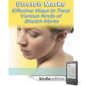 STRETCH MARKS! Various Kinds of Stretch Marks & Effective ways to Treat Them