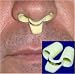 Snoreben (TM) - Stop Snoring, Quit Snoring and Apnea and Start a Quiet Nights Sleep (Three Sized Devices in a Pack)