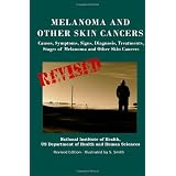 Melanoma And Other Skin Cancers: Causes, Symptoms, Signs, Diagnosis, Treatments, Stages of Melanoma and Other Skin Cancers