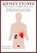 Kidney Stones: Prevention is Better Than Cure - Straightforward Guide To Understanding and Dealing Effectively With the Condition