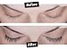 Latisse (FDA approved) eyelash treatment