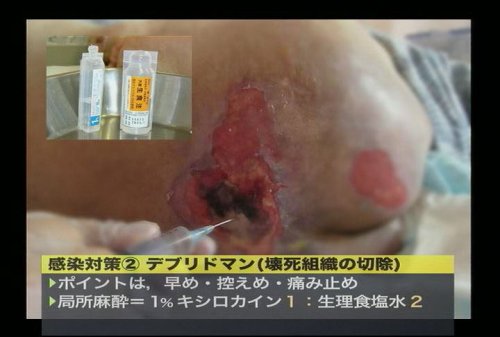 Cover image : 褥創治療最前線！Dr.鳥谷部の超ラップ療法 ケアネットDVD