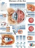 Diseases of the Eye Chart