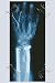 Canvas Print, Arm and Finger Repair - 12 x 18