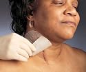 Mepiform&reg; Self-Adherent Silicone Dressing for Scar Management, 2" x 3"