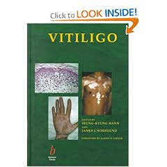 Vitiligo: A Monograph on the Basic and Clinical Science by James Nordlund