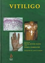 Vitiligo: A Comprehensive Monograph on Basic and Clinical Science