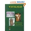 Vitiligo: A Monograph on the Basic and Clinical Science