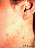 Wart Mix Capsules