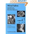 Mitral Valve: Floppy Mitral Valve, Mitral Valve Prolapse, Mitral Valvular Regurgitation