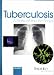 Book Tuberculosis (States-of-the-Art Series)