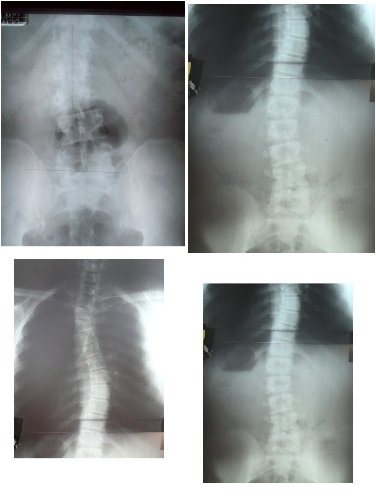 The Back Pain Choice