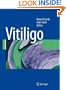 Vitiligo