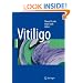 Vitiligo