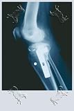 Canvas Print, Knee Replacement - 12 x 18