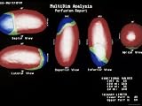 Myocardial Perfusion Scan Multidimension. Analysis Photographic Poster Print, 16x12