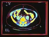 CT Scan, Abdomen 66 Year Old Woman Photographic Poster Print, 24x18