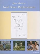 Your Guide to Total Knee Replacement
